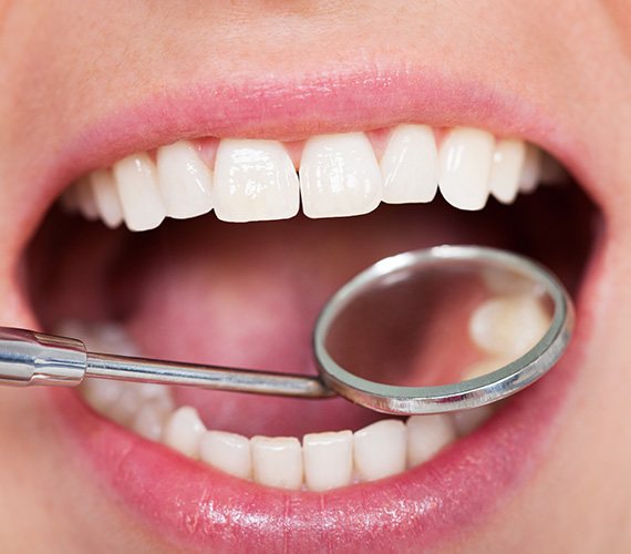 Close-up of tooth-colored resin on tooth in Fort Worth