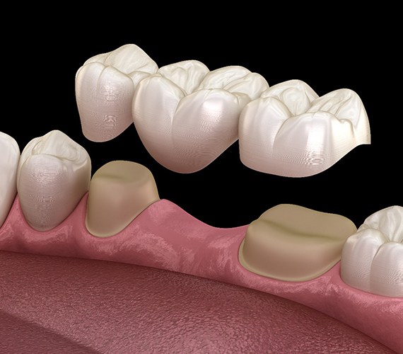 3D model of a dental bridge