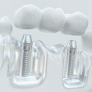 Model of implant dentures