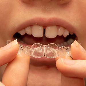 How is Invisalign Teen different