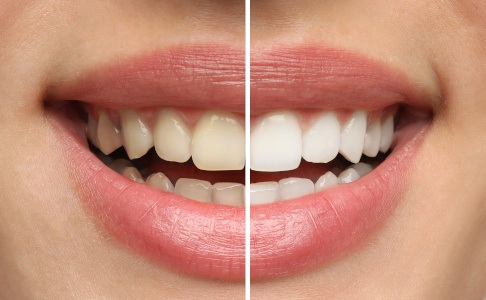 A collage with photos of a woman before and after teeth whitening